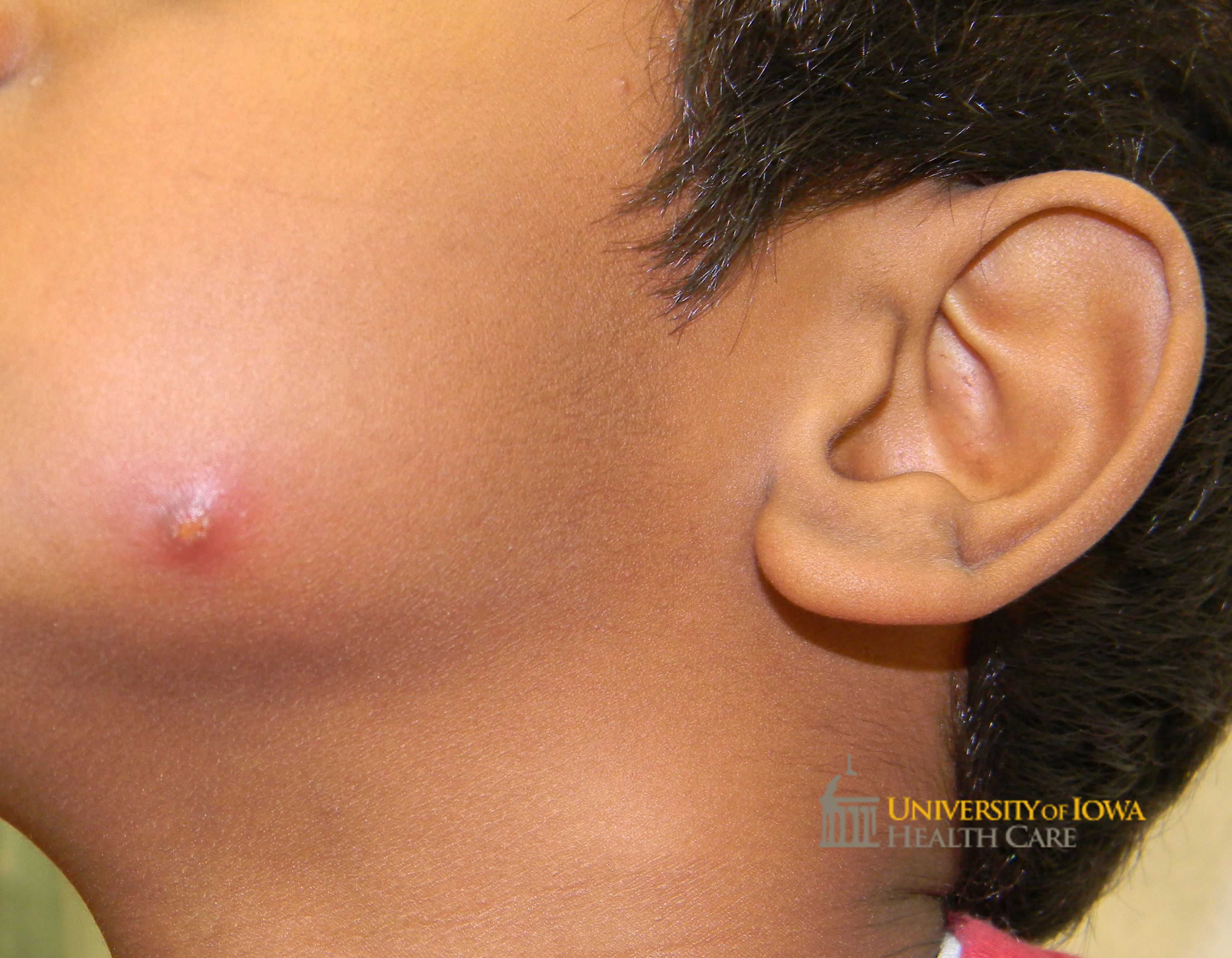 Yellow papule with surrounding erythema on the cheek. (click images for higher resolution).